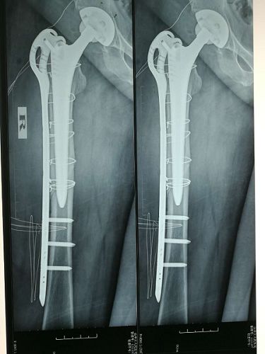   近日，棗莊市山亭區(qū)人民醫(yī)院骨外科成功首次為一名老年女性患者實(shí)施了假體周圍骨折翻修術(shù)?；颊呦祬^(qū)內(nèi)一名老年女性患者，前些時(shí)候不小心摔倒，導(dǎo)致右腿腫疼，家人發(fā)現(xiàn)后，撥打120送入棗莊市山亭區(qū)人民醫(yī)院急救治療，治療檢查時(shí)，發(fā)現(xiàn)該老人一年前曾因摔傷導(dǎo)致右股骨頸骨折在棗莊市山亭區(qū)人民醫(yī)院做過右髖關(guān)節(jié)置換術(shù)，這次意外摔倒，又導(dǎo)致假體周圍骨折，檢查后，接診醫(yī)師以“右股骨骨折”收入醫(yī)院骨外科。