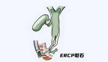 病程短、負擔輕！山東大學齊魯醫(yī)院德州醫(yī)院肝膽外科在中心院區(qū)復合手術(shù)室一次性完成兩項手術(shù)